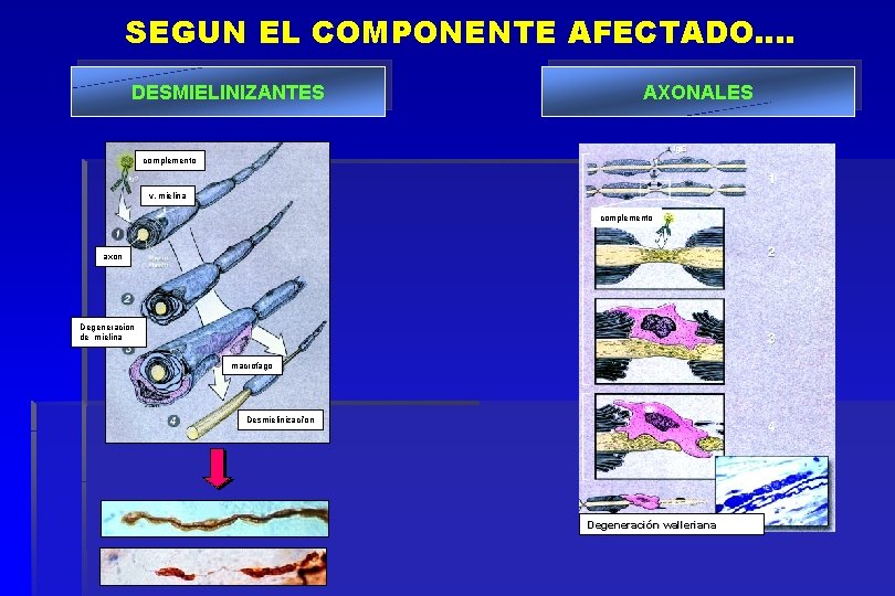 SEGUN EL COMPONENTE AFECTADO…. DESMIELINIZANTES AXONALES complemento v. mielina complemento axon Degeneracion de mielina