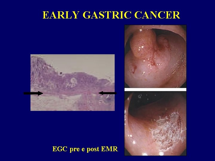 EARLY GASTRIC CANCER EGC pre e post EMR 