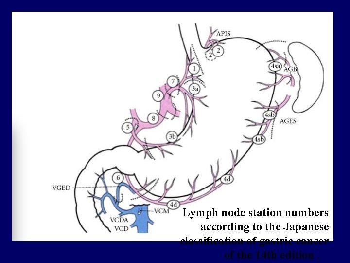Lymph node station numbers according to the Japanese classification of gastric cancer of the