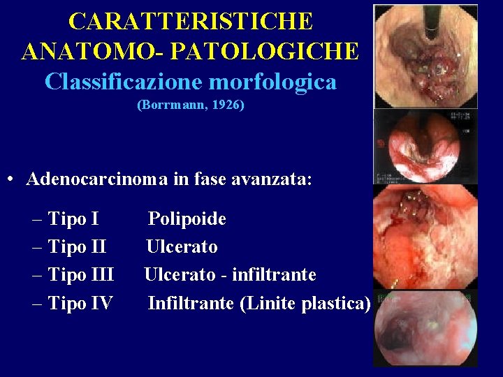 CARATTERISTICHE ANATOMO- PATOLOGICHE Classificazione morfologica (Borrmann, 1926) • Adenocarcinoma in fase avanzata: – Tipo