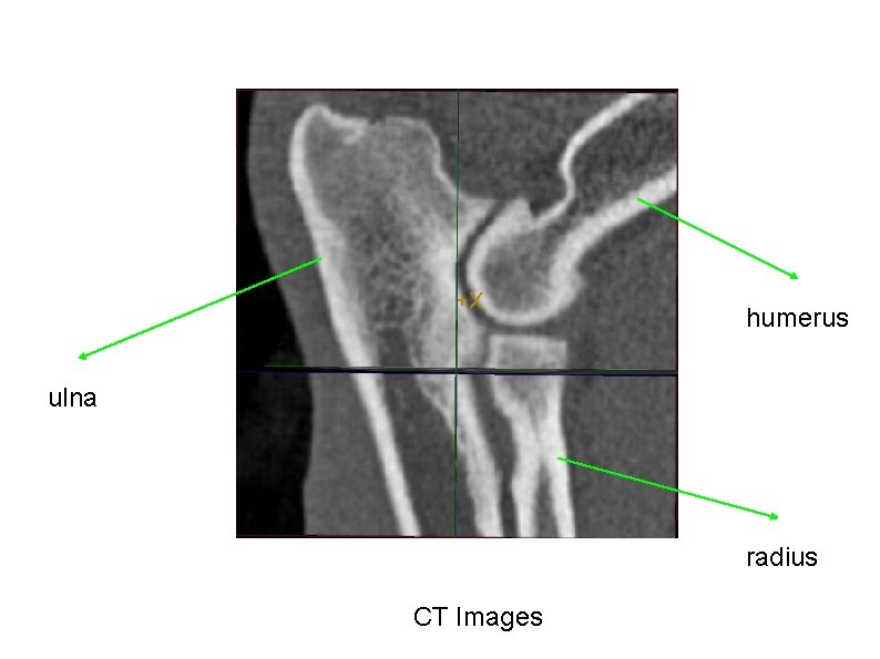 humerus ulna radius CT Images 