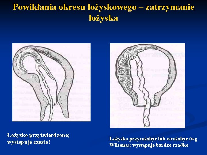 Powikłania okresu łożyskowego – zatrzymanie łożyska Łożysko przytwierdzone; występuje często! Łożysko przyrośnięte lub wrośnięte