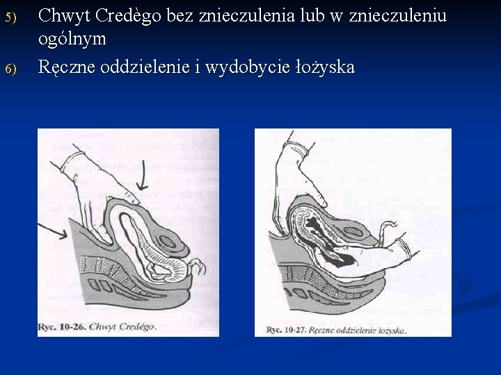 5) 6) Chwyt Credègo bez znieczulenia lub w znieczuleniu ogólnym Ręczne oddzielenie i wydobycie