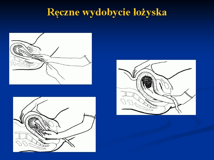 Ręczne wydobycie łożyska 