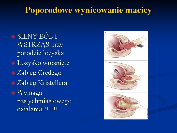 Poporodowe wynicowanie macicy SILNY BÓŁ I WSTRZĄS przy porodzie łożyska Łożysko wrośnięte Zabieg Credego
