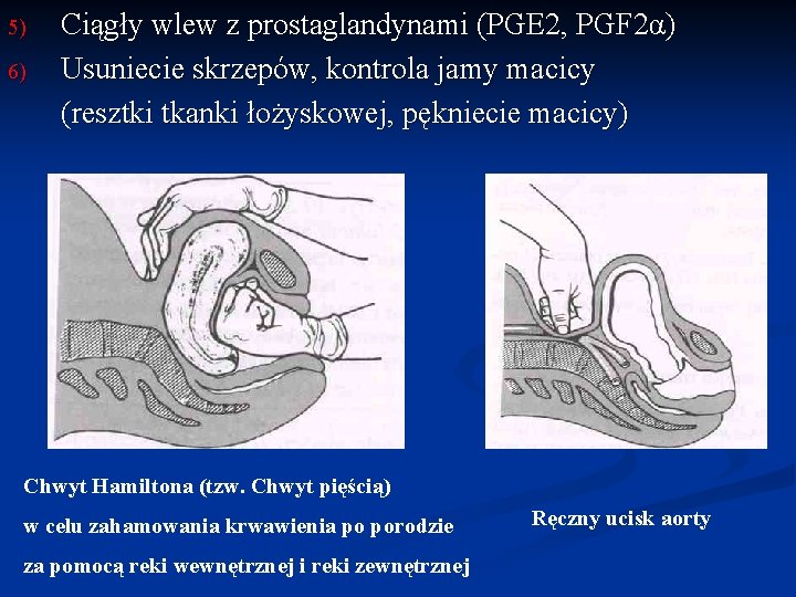 5) 6) Ciągły wlew z prostaglandynami (PGE 2, PGF 2α) Usuniecie skrzepów, kontrola jamy
