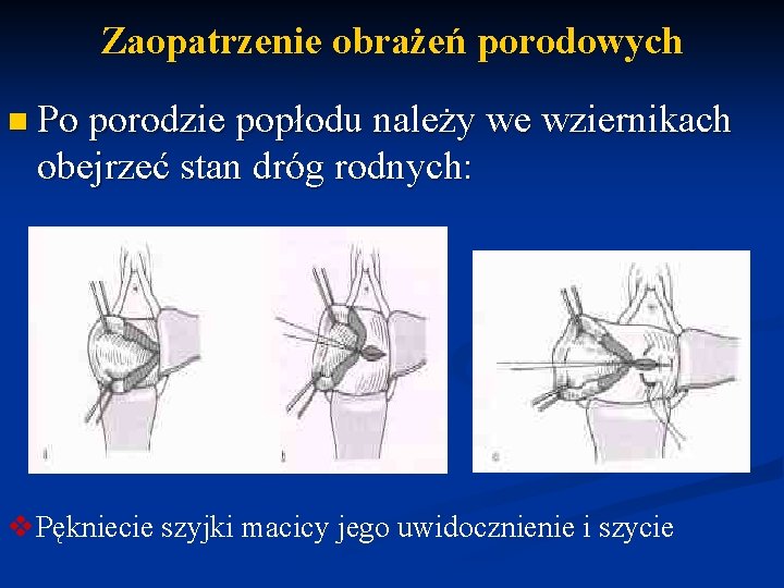 Zaopatrzenie obrażeń porodowych n Po porodzie popłodu należy we wziernikach obejrzeć stan dróg rodnych: