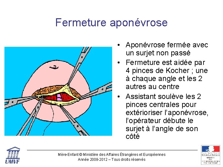 Fermeture aponévrose • Aponévrose fermée avec un surjet non passé • Fermeture est aidée