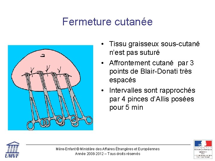 Fermeture cutanée • Tissu graisseux sous-cutané n’est pas suturé • Affrontement cutané par 3