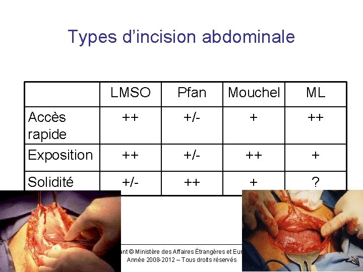 Types d’incision abdominale LMSO Pfan Mouchel ML Accès rapide Exposition ++ +/- + ++