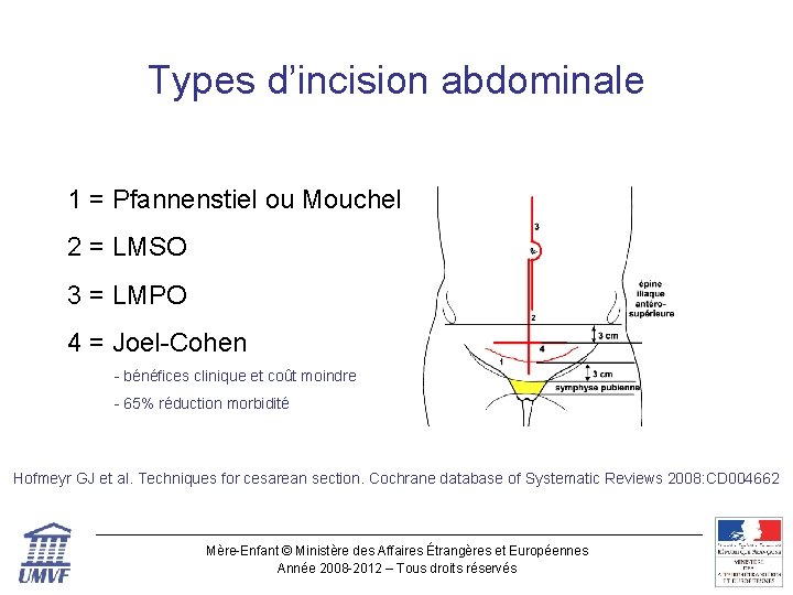 Types d’incision abdominale 1 = Pfannenstiel ou Mouchel 2 = LMSO 3 = LMPO