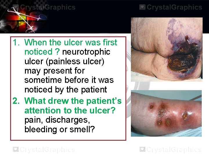 1. When the ulcer was first noticed ? neurotrophic ulcer (painless ulcer) may present