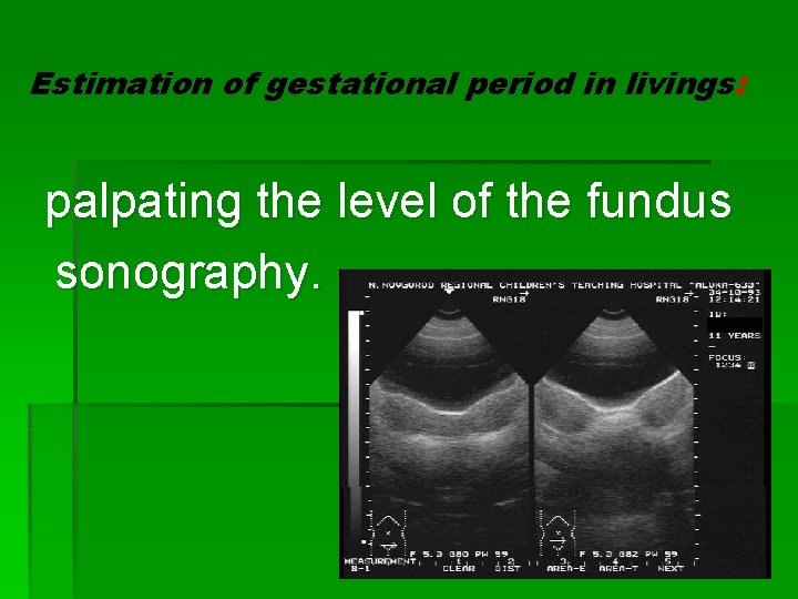 Estimation of gestational period in livings: palpating the level of the fundus sonography. 