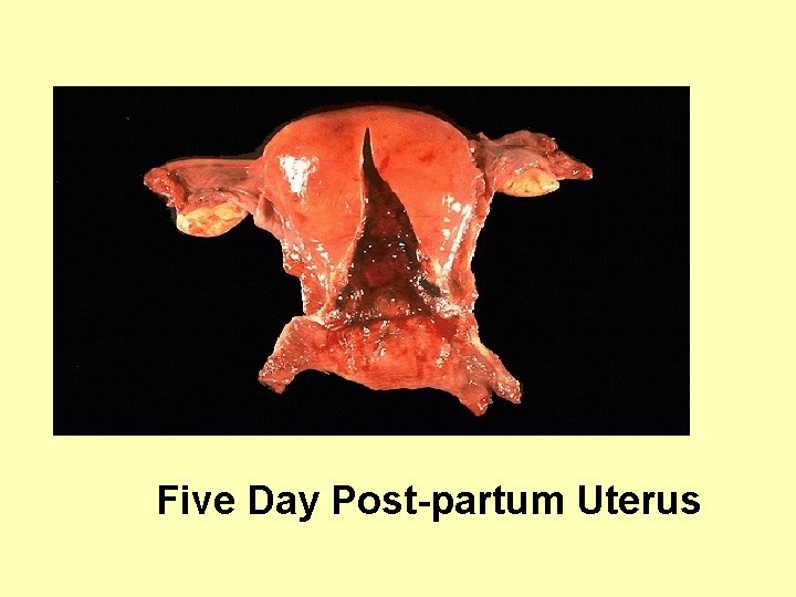 Five Day Post-partum Uterus 