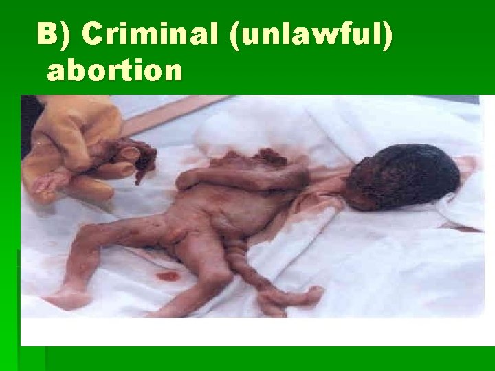 B) Criminal (unlawful) abortion 