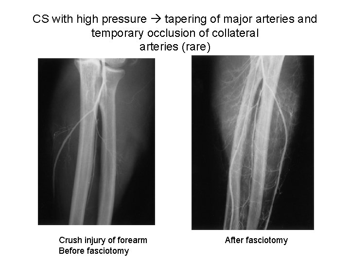 CS with high pressure tapering of major arteries and temporary occlusion of collateral arteries
