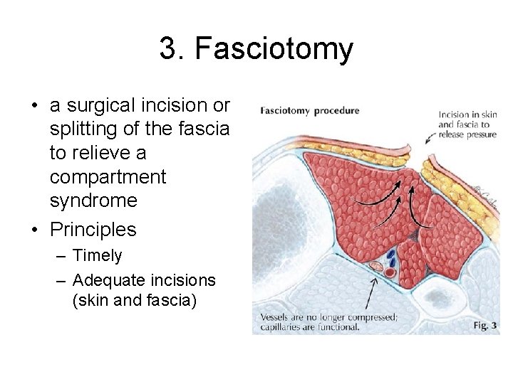 3. Fasciotomy • a surgical incision or splitting of the fascia to relieve a