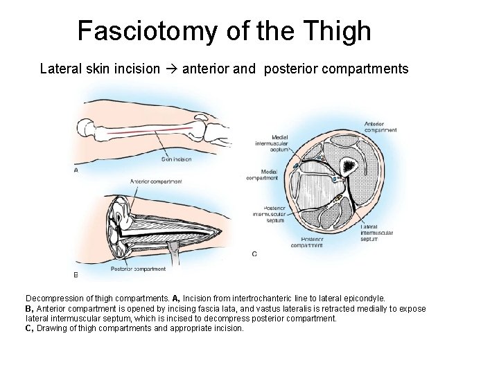 Fasciotomy of the Thigh Lateral skin incision anterior and posterior compartments Decompression of thigh