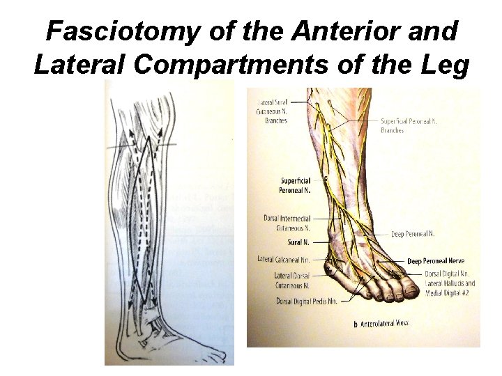 Fasciotomy of the Anterior and Lateral Compartments of the Leg 