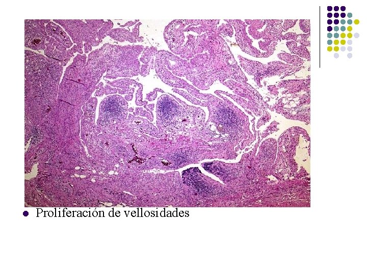 l Proliferación de vellosidades l Proliferación de vellosidades