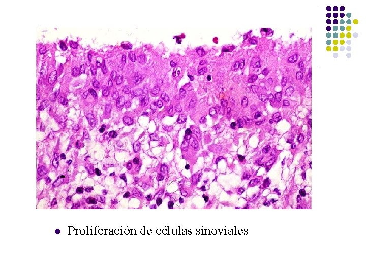 l Proliferación de células sinoviales l Proliferación de células sinoviales