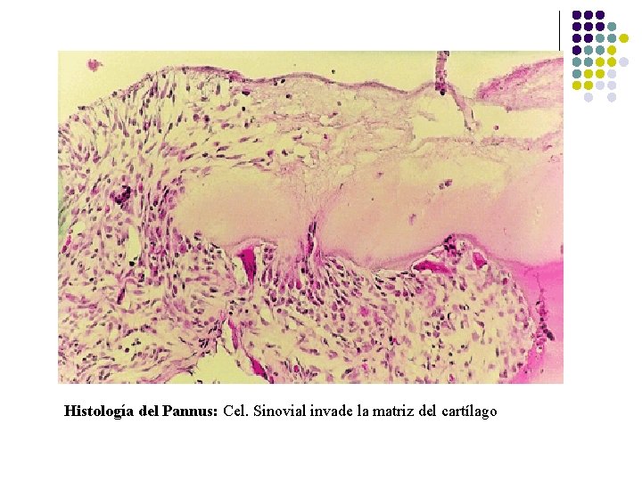 Histología del Pannus: Cel. Sinovial invade la matriz del cartílago Histología del Pannus: Cel. Sinovial invade la matriz del cartílago