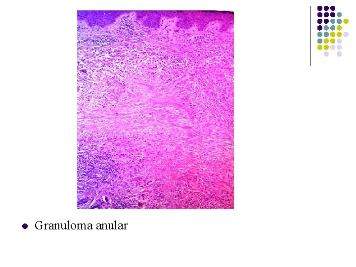 l Granuloma anular l Granuloma anular
