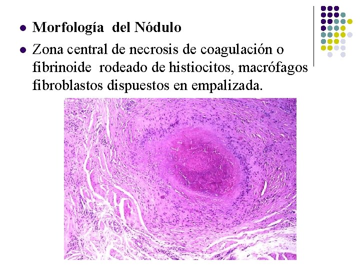 l l Morfología del Nódulo Zona central de necrosis de coagulación o fibrinoide rodeado l l Morfología del Nódulo Zona central de necrosis de coagulación o fibrinoide rodeado