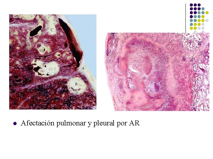 l Afectación pulmonar y pleural por AR l Afectación pulmonar y pleural por AR