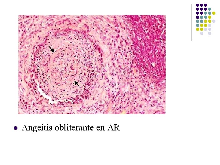 l Angeítis obliterante en AR l Angeítis obliterante en AR