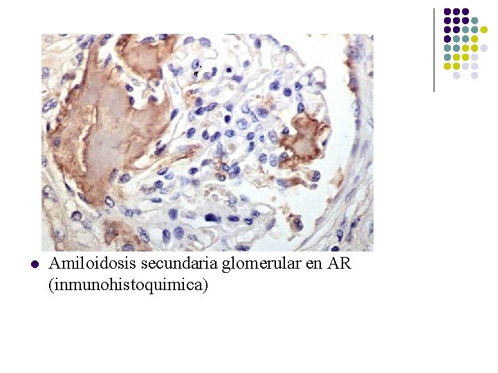 l Amiloidosis secundaria glomerular en AR (inmunohistoquimica) l Amiloidosis secundaria glomerular en AR (inmunohistoquimica)