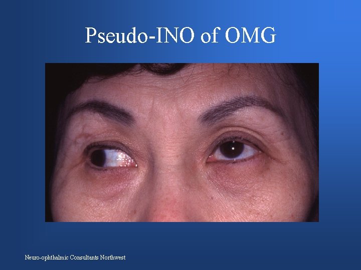 Pseudo-INO of OMG Neuro-ophthalmic Consultants Northwest 