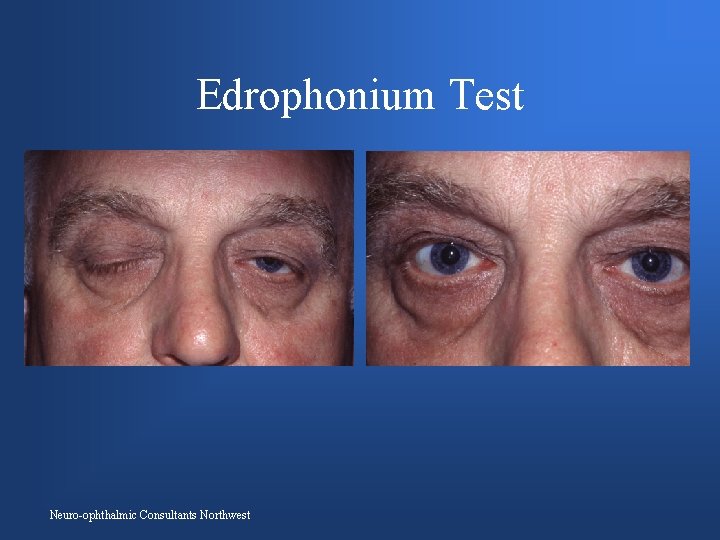 Edrophonium Test Neuro-ophthalmic Consultants Northwest 