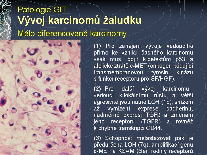 Patologie GIT Vývoj karcinomů žaludku Málo diferencované karcinomy (1) Pro zahájení vývoje vedoucího přímo Patologie GIT Vývoj karcinomů žaludku Málo diferencované karcinomy (1) Pro zahájení vývoje vedoucího přímo