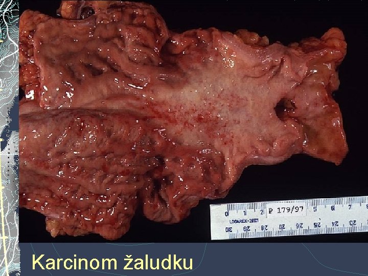 Karcinom žaludku Karcinom žaludku