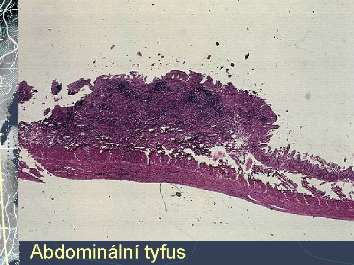 Abdominální tyfus Abdominální tyfus