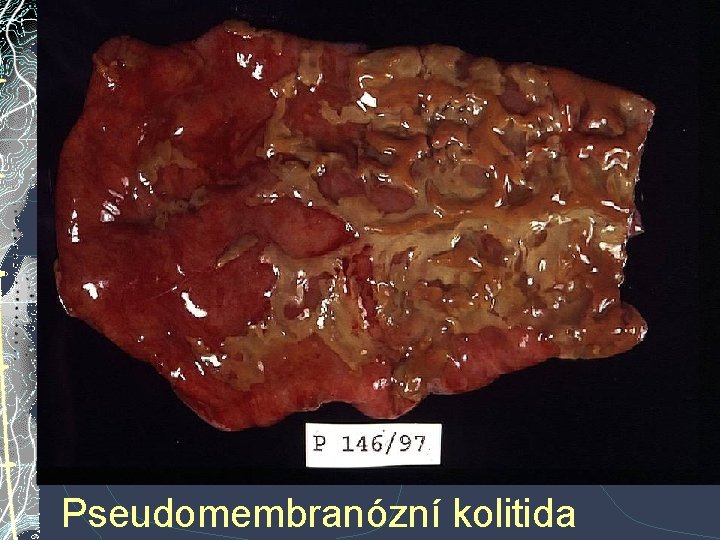 Pseudomembranózní kolitida Pseudomembranózní kolitida