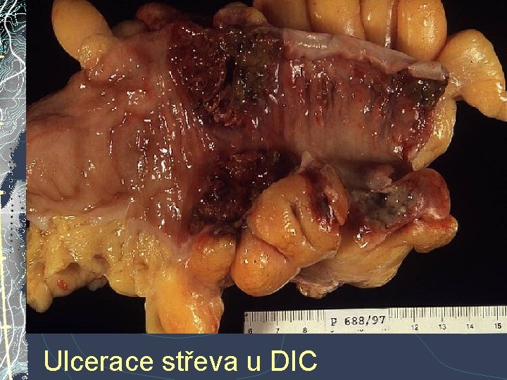 Ulcerace střeva u DIC Ulcerace střeva u DIC