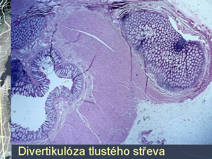 Divertikulóza tlustého střeva Divertikulóza tlustého střeva