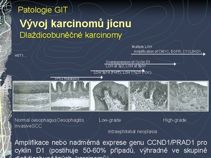 Patologie GIT Vývoj karcinomů jícnu Dlaždicobuněčné karcinomy Multiple LOH Amplification of CMYC, EGFR, CYCLIN Patologie GIT Vývoj karcinomů jícnu Dlaždicobuněčné karcinomy Multiple LOH Amplification of CMYC, EGFR, CYCLIN