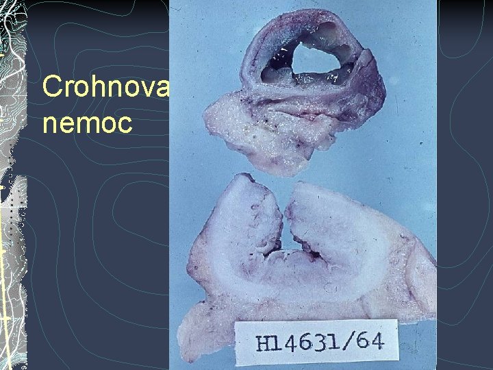 Crohnova nemoc Crohnova nemoc