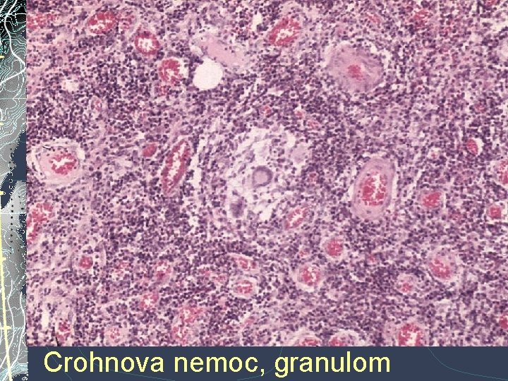 Crohnova nemoc, granulom Crohnova nemoc, granulom