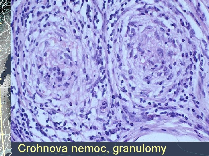 Crohnova nemoc, granulomy Crohnova nemoc, granulomy