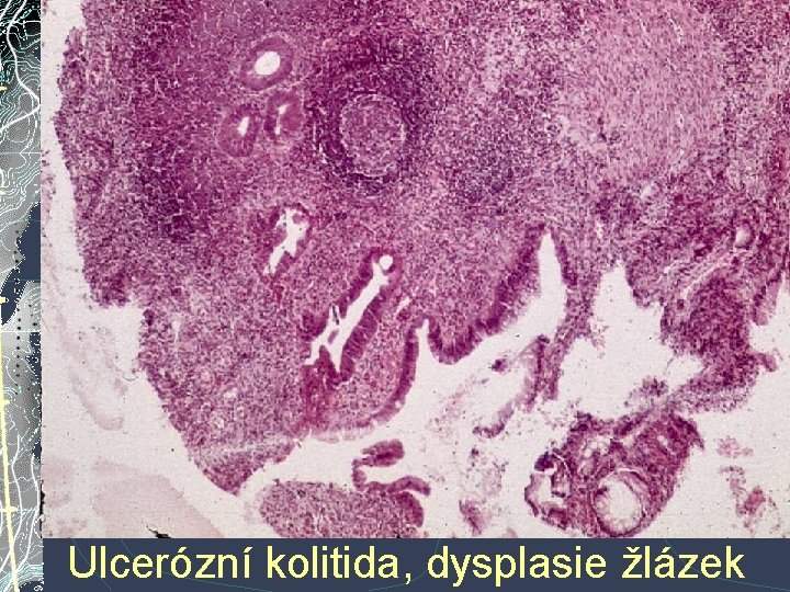Ulcerózní kolitida, dysplasie žlázek Ulcerózní kolitida, dysplasie žlázek