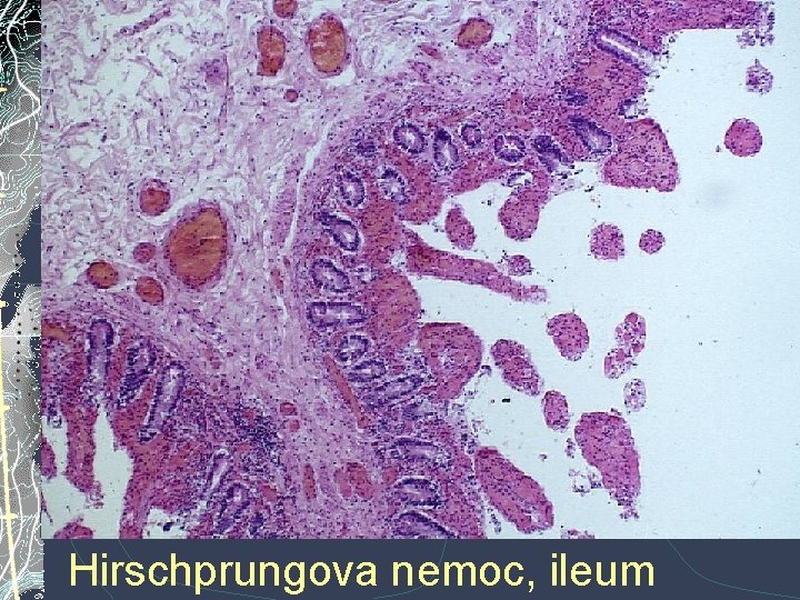 Hirschprungova nemoc, ileum Hirschprungova nemoc, ileum