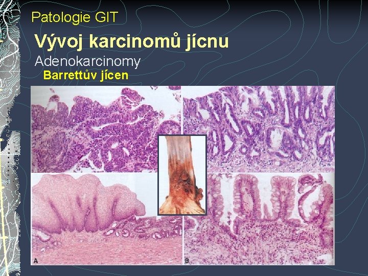 Patologie GIT Vývoj karcinomů jícnu Adenokarcinomy Barrettův jícen Patologie GIT Vývoj karcinomů jícnu Adenokarcinomy Barrettův jícen