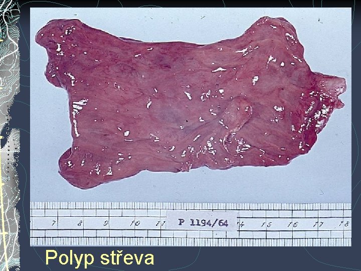 Polyp střeva Polyp střeva