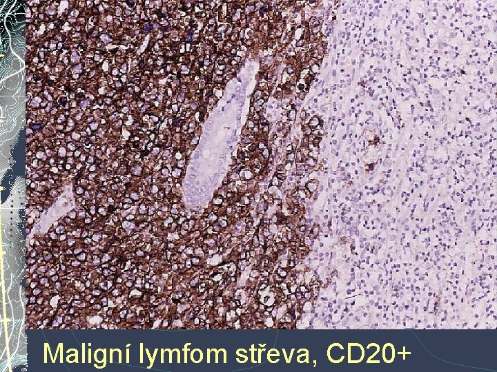 Maligní lymfom střeva, CD 20+ Maligní lymfom střeva, CD 20+