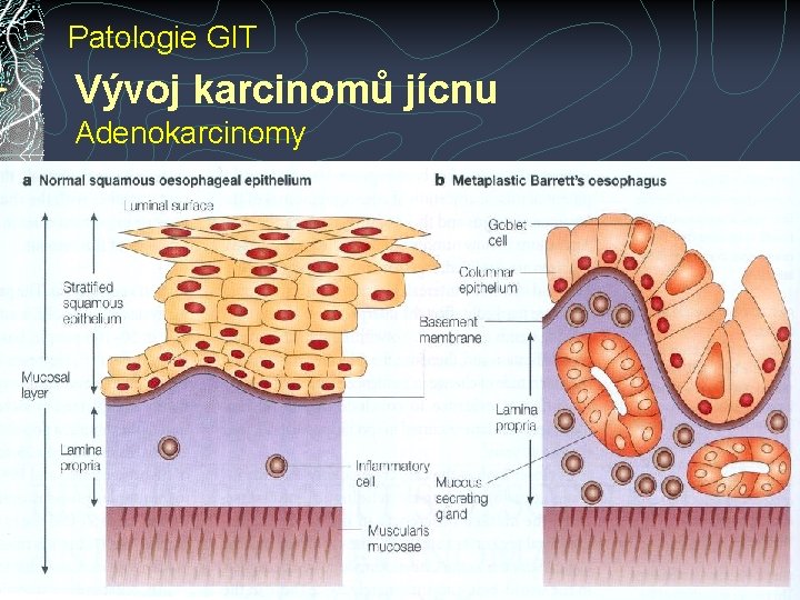 Patologie GIT Vývoj karcinomů jícnu Adenokarcinomy Patologie GIT Vývoj karcinomů jícnu Adenokarcinomy