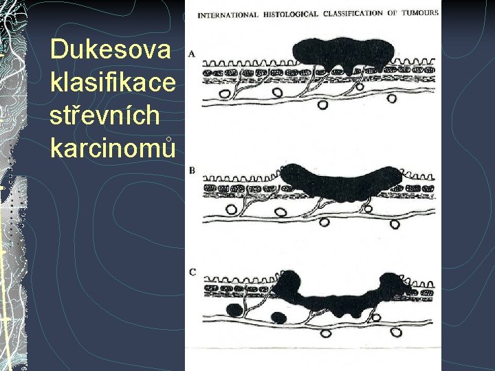 Dukesova klasifikace střevních karcinomů Dukesova klasifikace střevních karcinomů